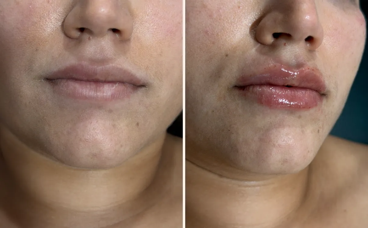 Lip Augmentation, lips, before and after