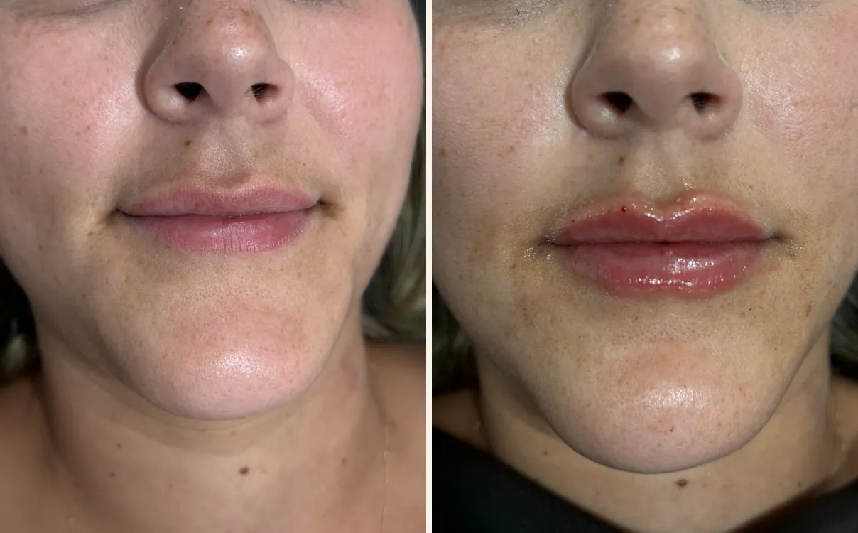 Lip Augmentation, lips, before and after