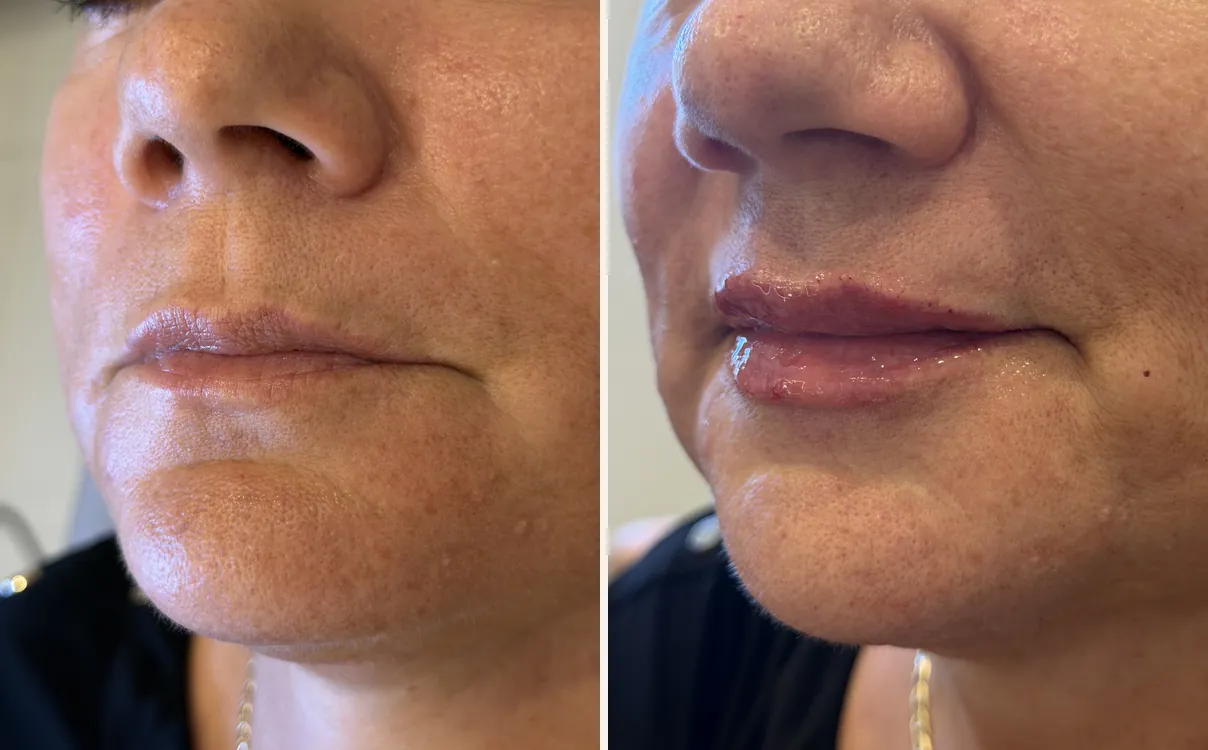 Lip Augmentation, lips, before and after