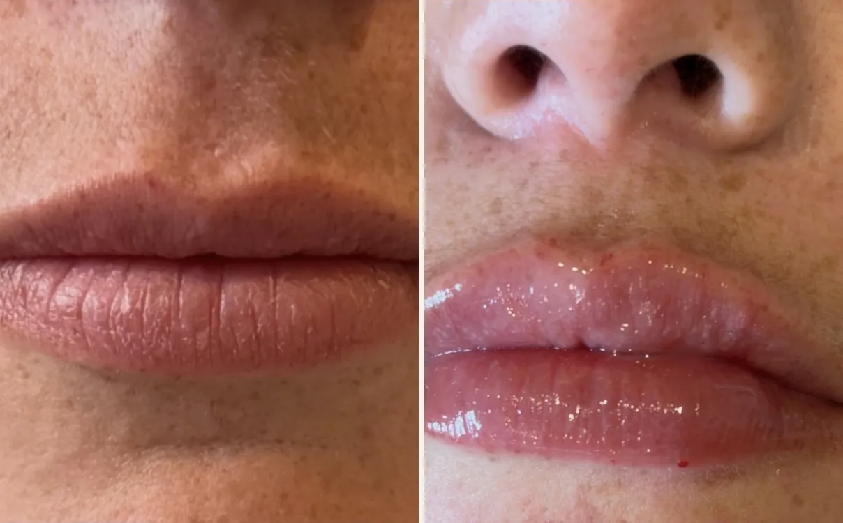 Lip Augmentation, lips, before and after