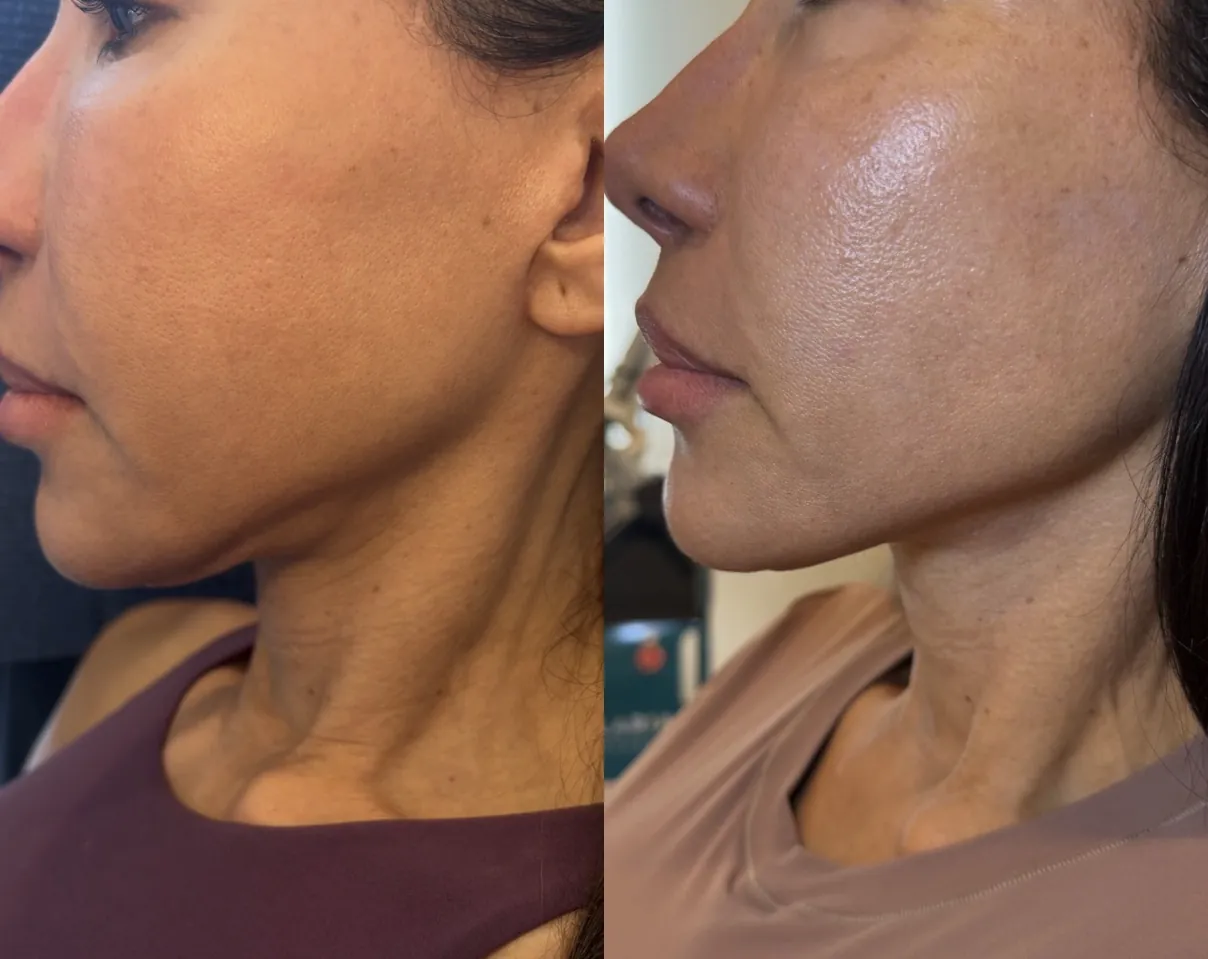 Morpheus8 (microneedling/RF), jawline and neck, before and after