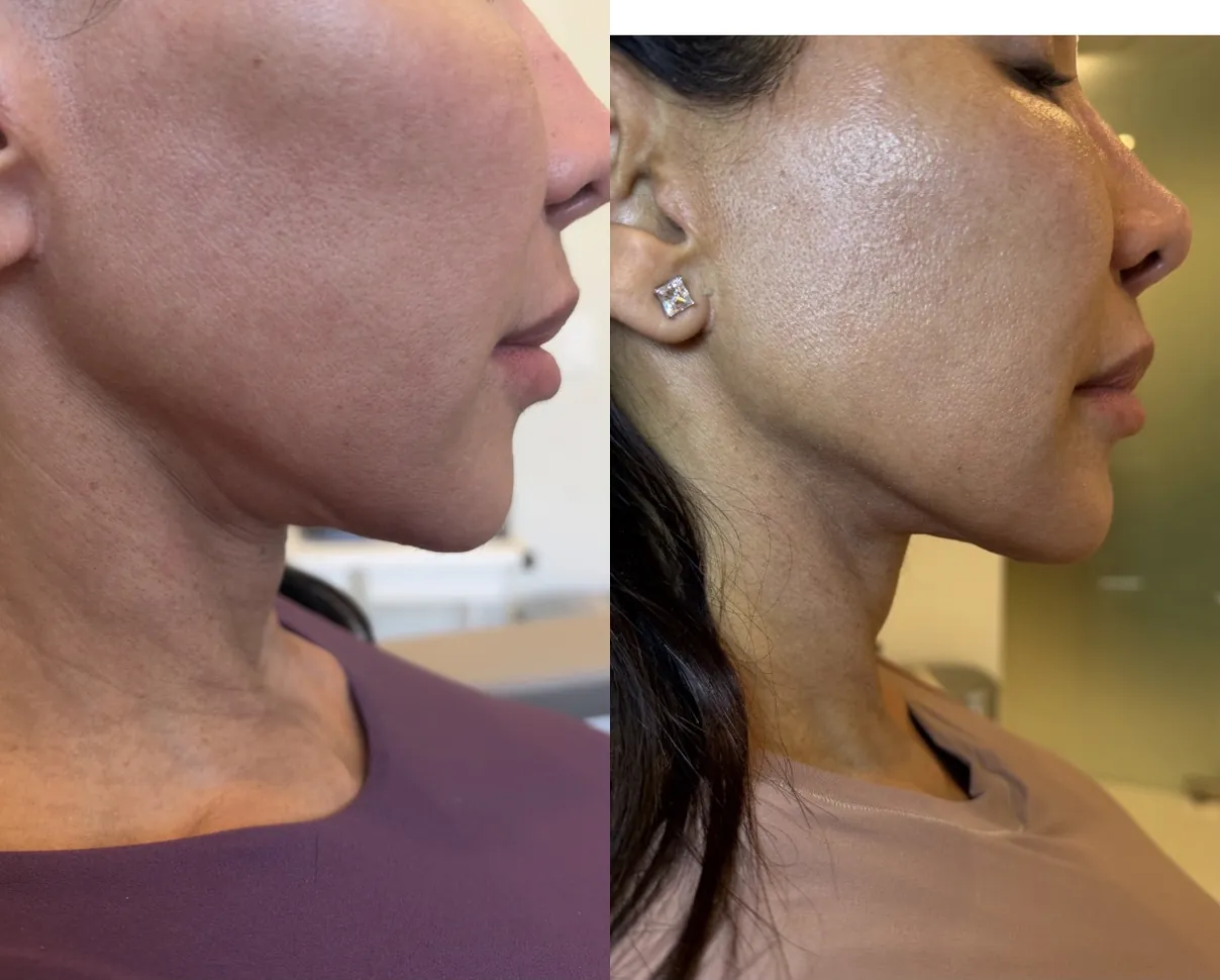 Morpheus8 (microneedling/RF), jawline and neck, before and after
